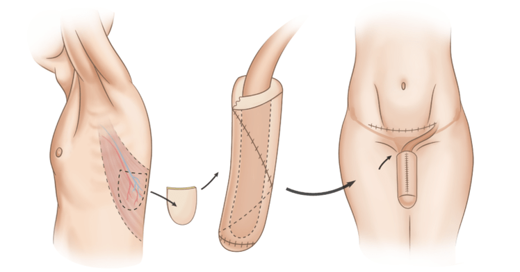 phalloplasty to enlarge the penis